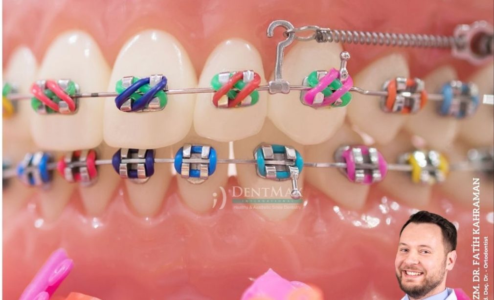 çocuk ortodontisi bakırköy istanbul balıkesir erken ortodonti tedavisi diş teli dentmax