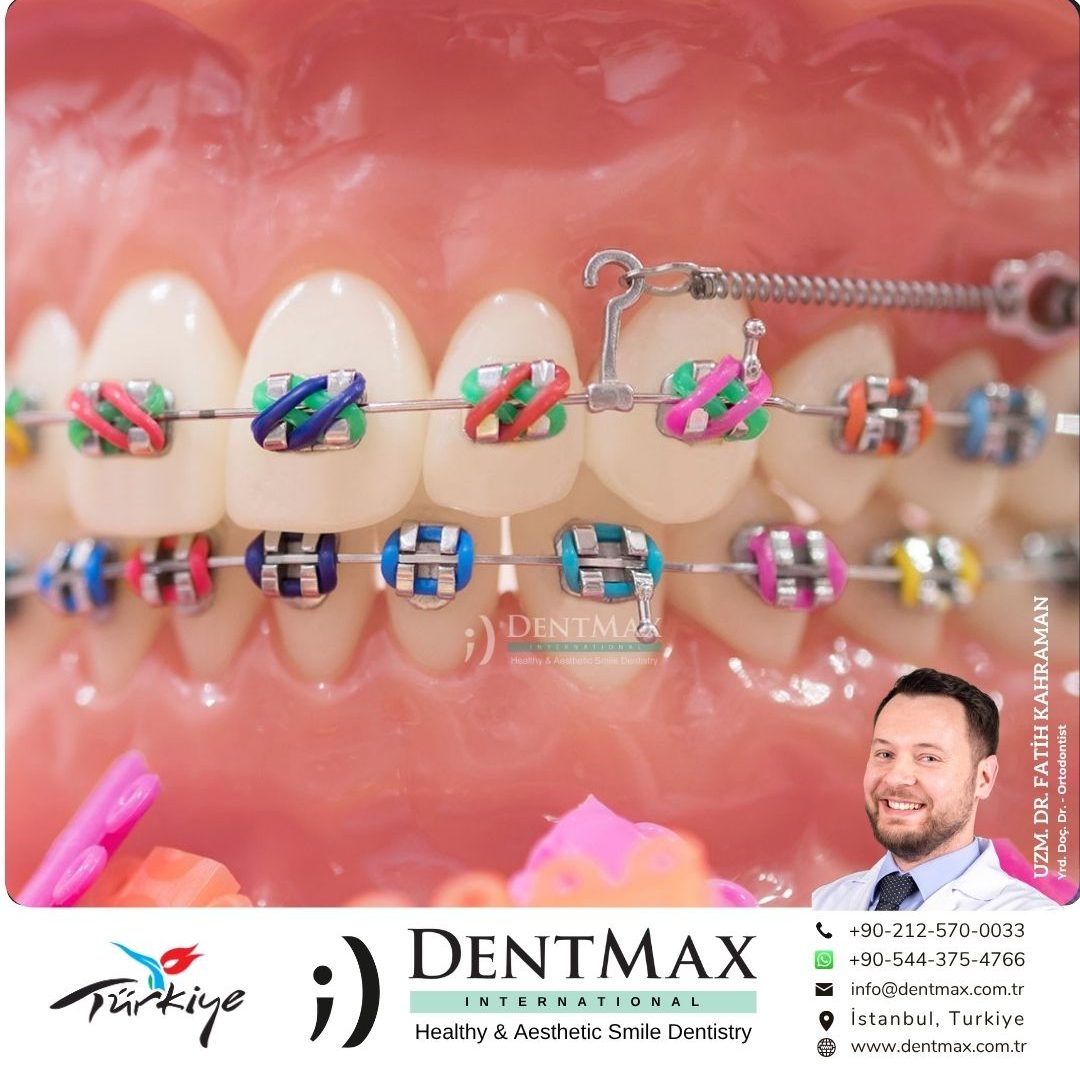 çocuk ortodontisi bakırköy istanbul balıkesir erken ortodonti tedavisi diş teli dentmax
