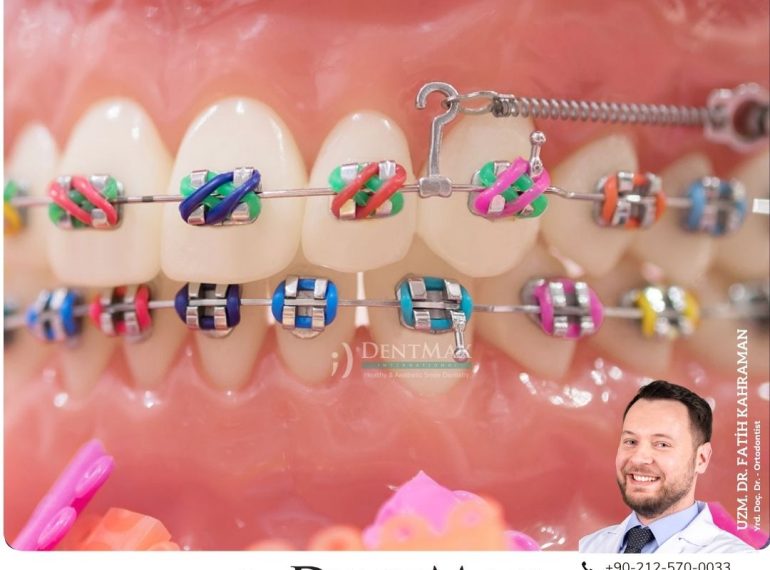 çocuk ortodontisi bakırköy istanbul balıkesir erken ortodonti tedavisi diş teli dentmax