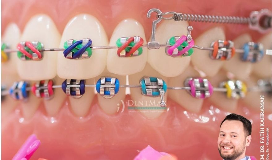 çocuk ortodontisi bakırköy istanbul balıkesir erken ortodonti tedavisi diş teli dentmax