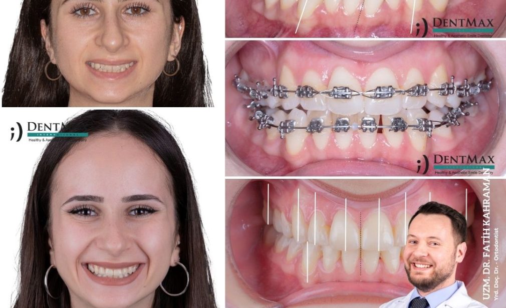 diş teli tedavisi metal estetik braket bakırköy istanbul balıkesir ortodonti dentmax