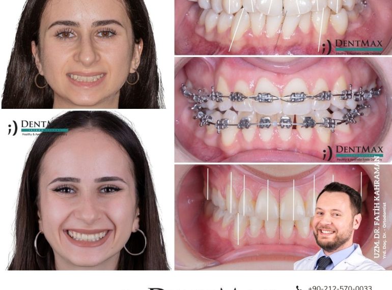 diş teli tedavisi metal estetik braket bakırköy istanbul balıkesir ortodonti dentmax