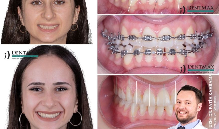 diş teli tedavisi metal estetik braket bakırköy istanbul balıkesir ortodonti dentmax