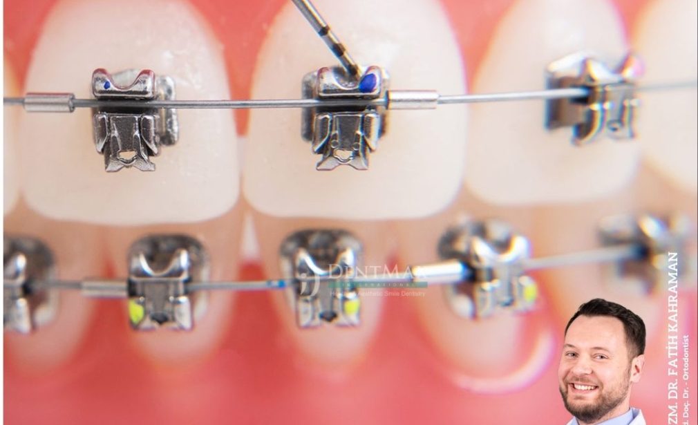 kapaklı braket diş teli tedavisi bakırköy istanbul balıkesir self ligating braket ortodonti dentmax