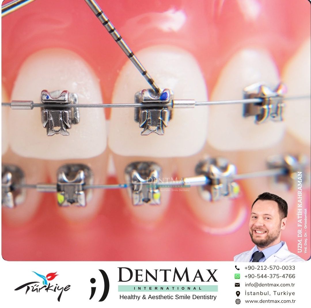 kapaklı braket diş teli tedavisi bakırköy istanbul balıkesir self ligating braket ortodonti dentmax