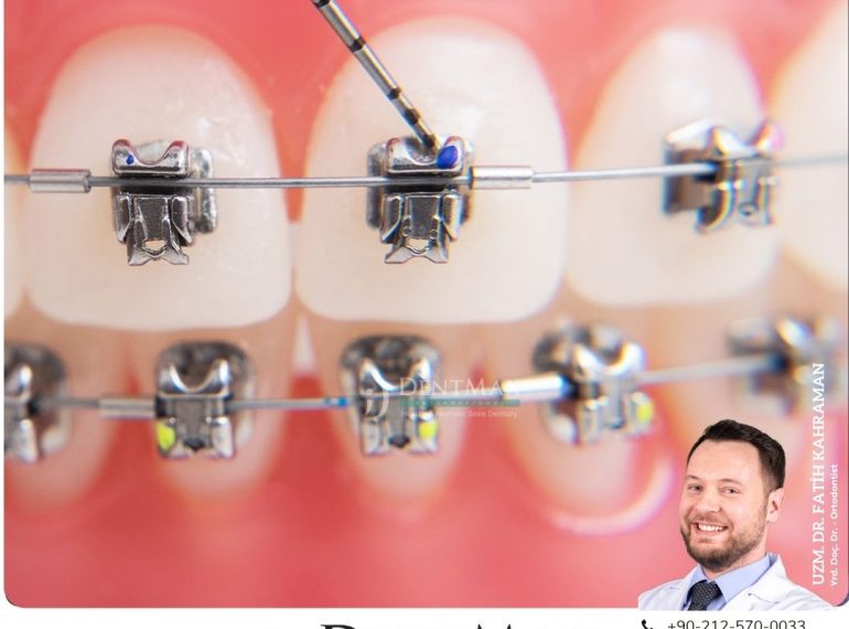 kapaklı braket diş teli tedavisi bakırköy istanbul balıkesir self ligating braket ortodonti dentmax