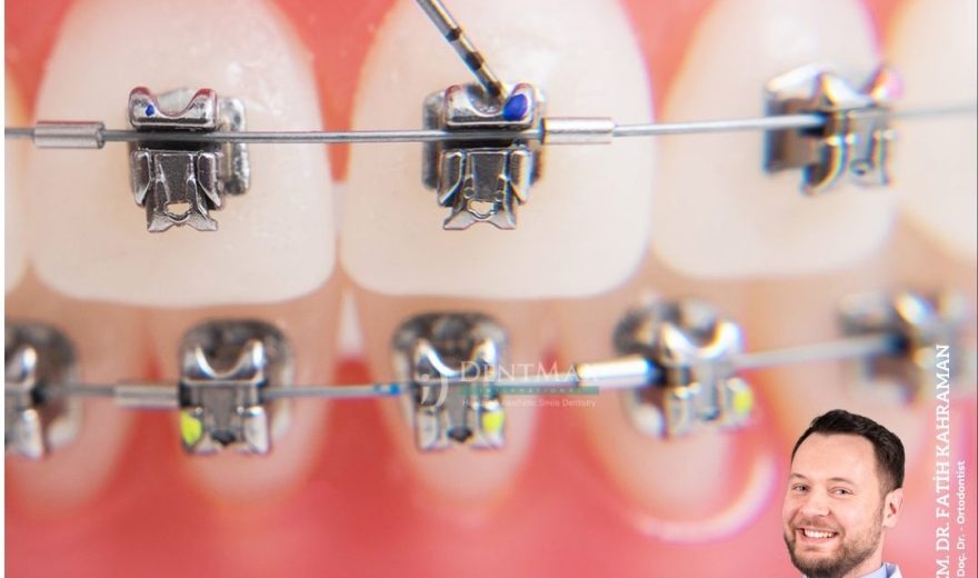 kapaklı braket diş teli tedavisi bakırköy istanbul balıkesir self ligating braket ortodonti dentmax