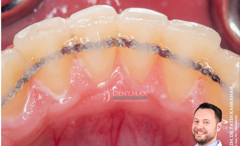 ortodontik pekiştirme tedavisi retainer teli essix retainer bakırköy istanbul balıkesir dentmax