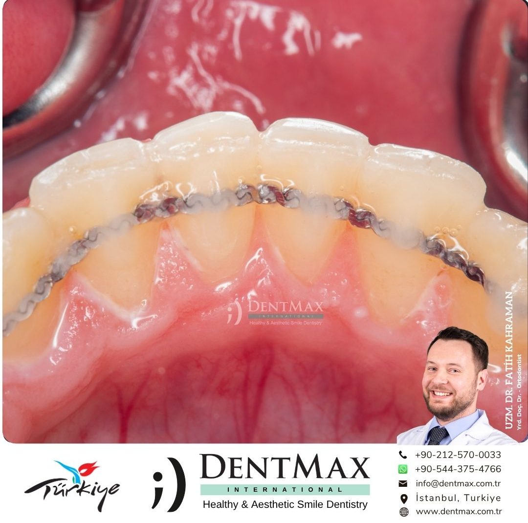 ortodontik pekiştirme tedavisi retainer teli essix retainer bakırköy istanbul balıkesir dentmax