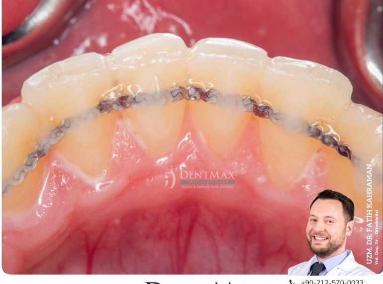 ortodontik pekiştirme tedavisi retainer teli essix retainer bakırköy istanbul balıkesir dentmax