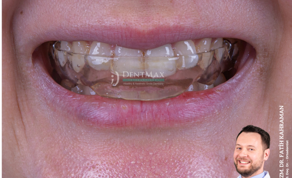 çene eklemi ağrısı tedavisi splint gece plağı diş sıkma bakırköy istanbul balıkesir dentmax