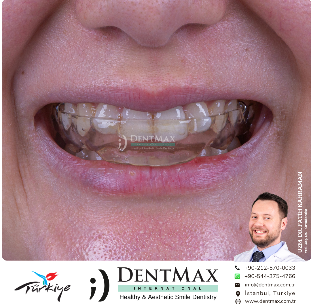 çene eklemi ağrısı tedavisi splint gece plağı diş sıkma bakırköy istanbul balıkesir dentmax