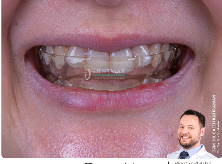 çene eklemi ağrısı tedavisi splint gece plağı diş sıkma bakırköy istanbul balıkesir dentmax