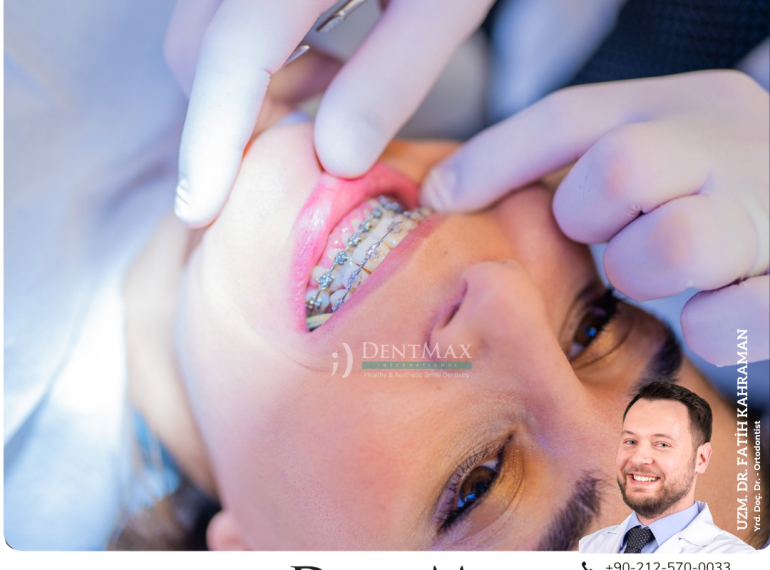 yetişkin ortodontisi istanbul bakırköy balıkesir invisalign diş teli erişkin ortodonti dentmax
