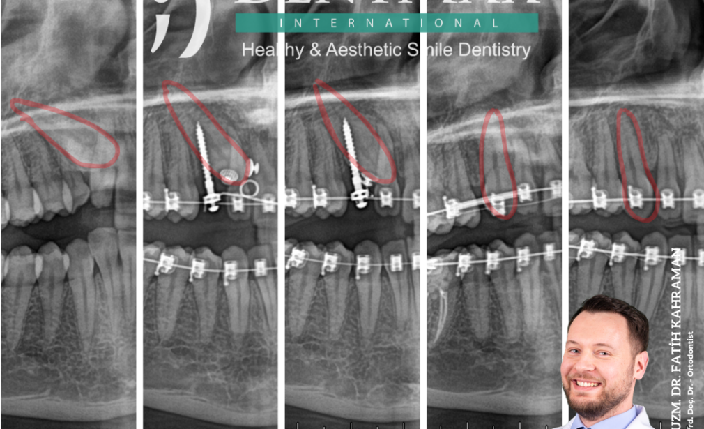 gömülü diş sürdürme ortodonti tedavisi bakırköy istanbul balıkesir ortodontik diş konumlandırma dentmax