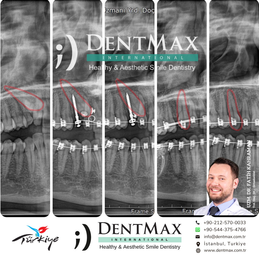 gömülü diş sürdürme ortodonti tedavisi bakırköy istanbul balıkesir ortodontik diş konumlandırma dentmax