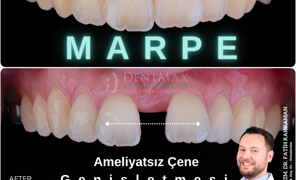 MARPE ameliyatsız çene genişletme ile gülüş değişimi öncesi sonrası İstanbul Balıkesir DentMax
