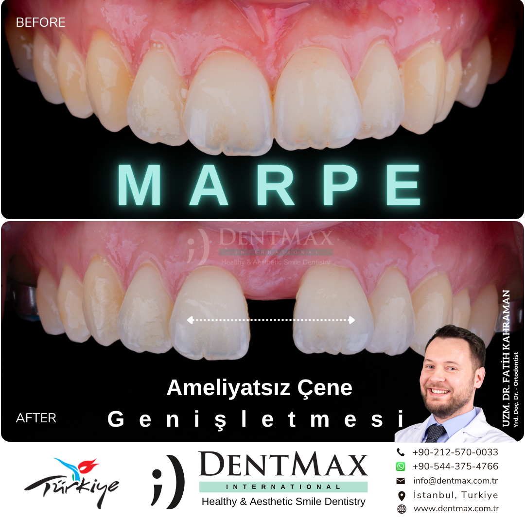 MARPE ameliyatsız çene genişletme ile gülüş değişimi öncesi sonrası İstanbul Balıkesir DentMax