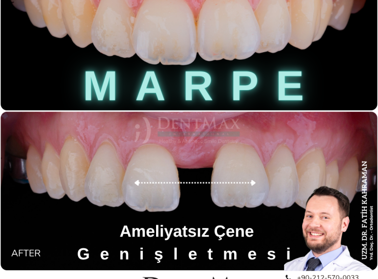 MARPE ameliyatsız çene genişletme ile gülüş değişimi öncesi sonrası İstanbul Balıkesir DentMax