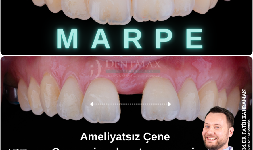 MARPE ameliyatsız çene genişletme ile gülüş değişimi öncesi sonrası İstanbul Balıkesir DentMax