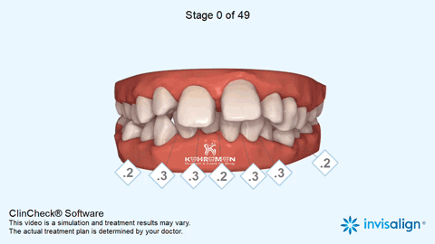 Telsiz ortodonti nasıl yapılır? Planlaması
